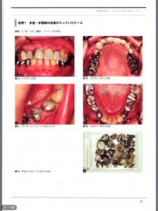 し　歯科金属　材料アレルギー　002